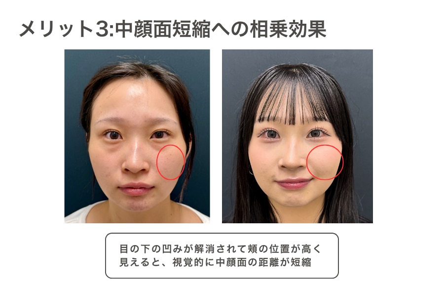 メリット3：頬の重心が上がり『中顔面短縮』への相乗効果