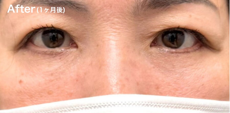 目の下の”たるみ”が気になる方！