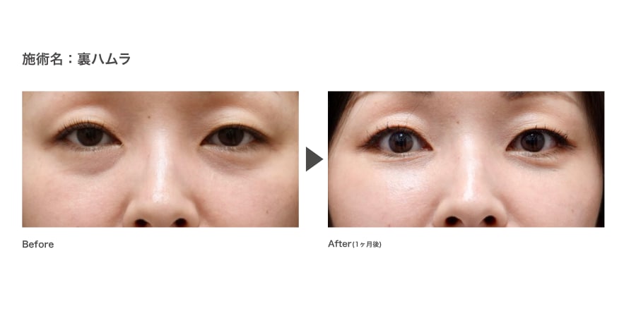 ③裏ハムラ<br />
