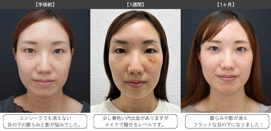 【手術前】【1週間】【1ヶ月】