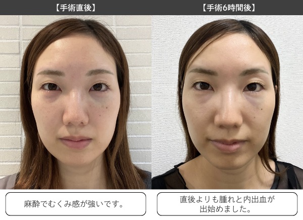 手術当日〜3日目（ダウンタイムのピーク）