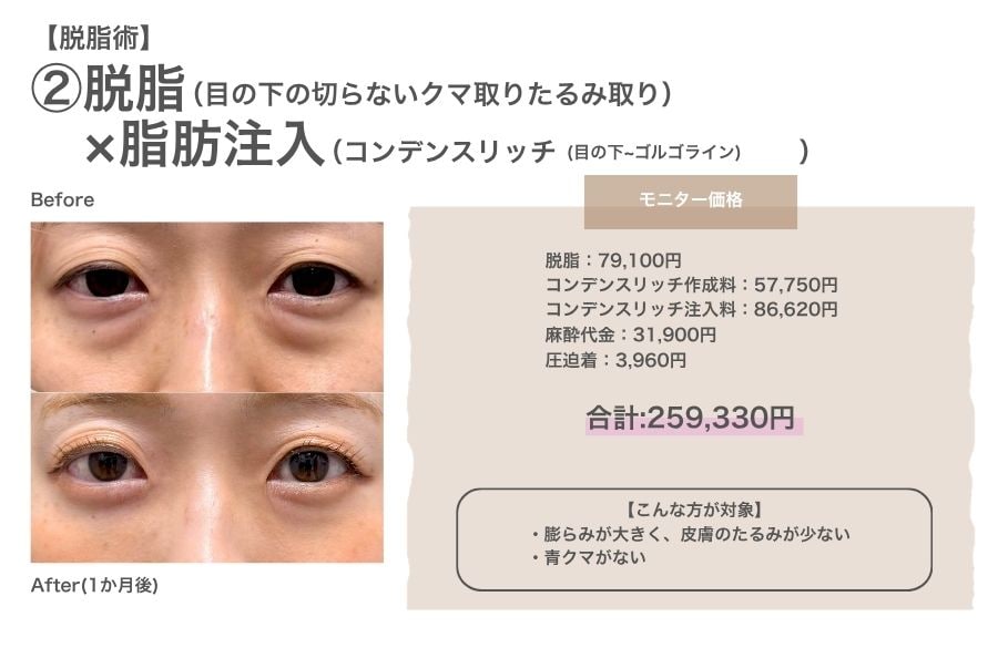 ②脱脂×コンデンスリッチ（脂肪注入）