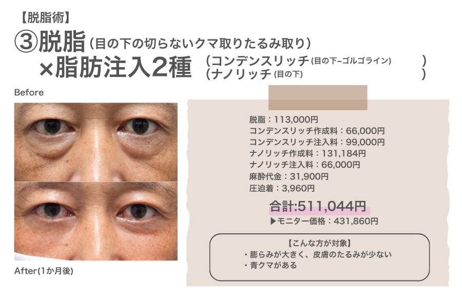 脱脂×コンデンスリッチ×ナノリッチ併用のリアルな費用と症例写真