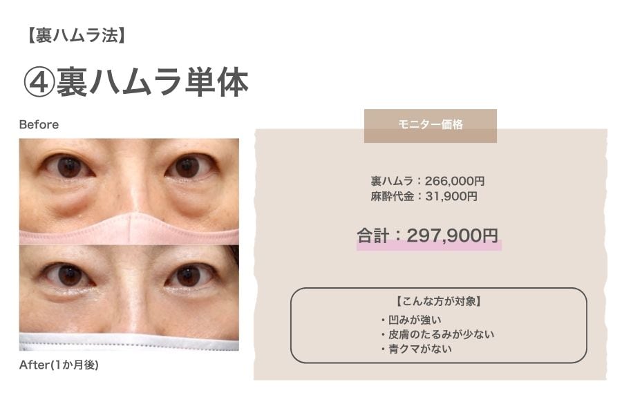 ④裏ハムラ法