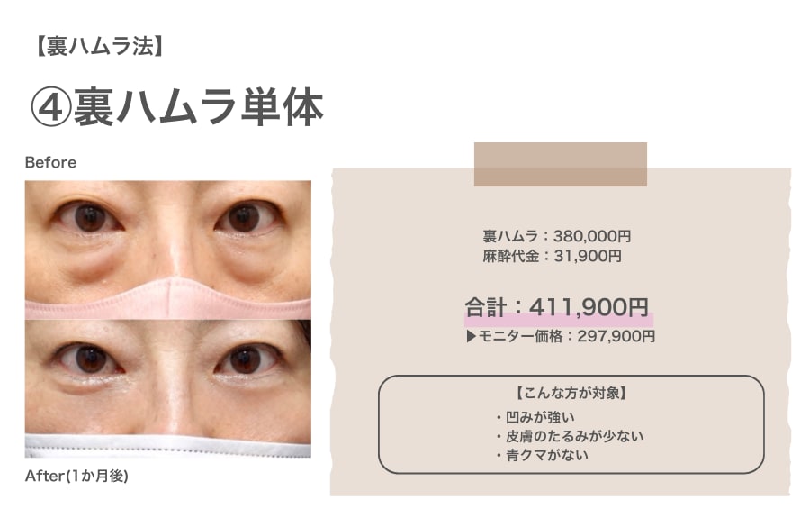 裏ハムラ法のリアルな費用と症例写真