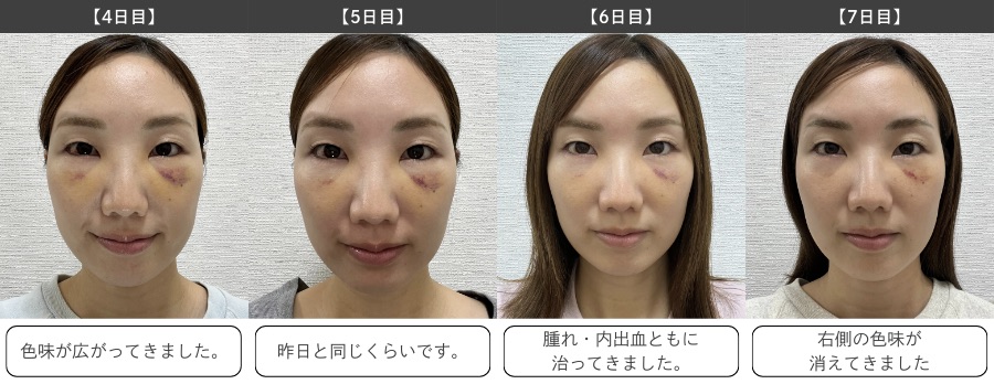 術後4日目〜1週間（社会復帰の目安）