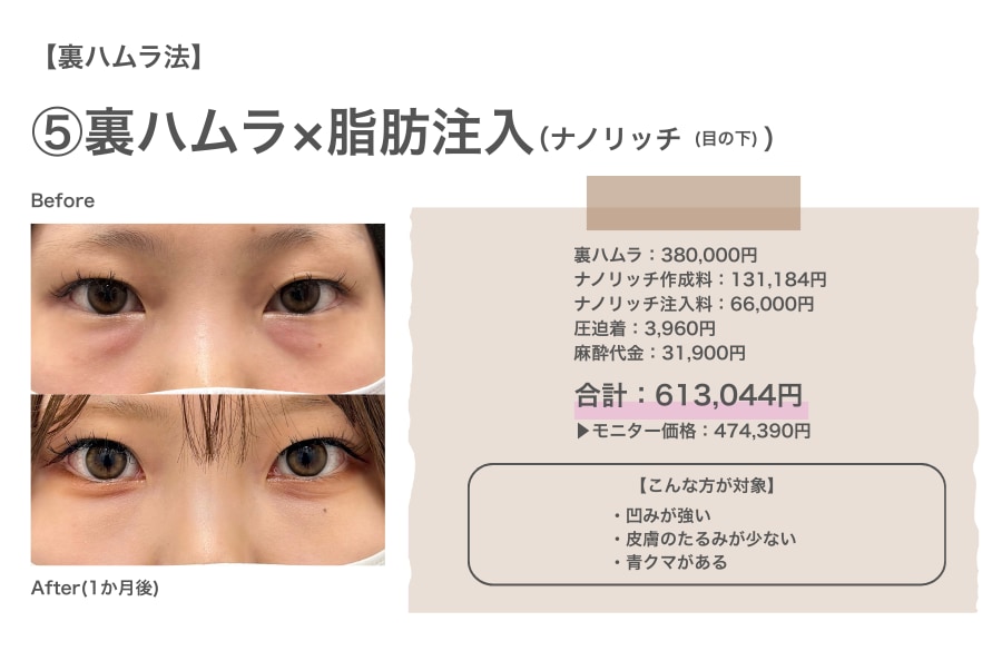裏ハムラ法×ナノリッチ併用のリアルな費用と症例写真