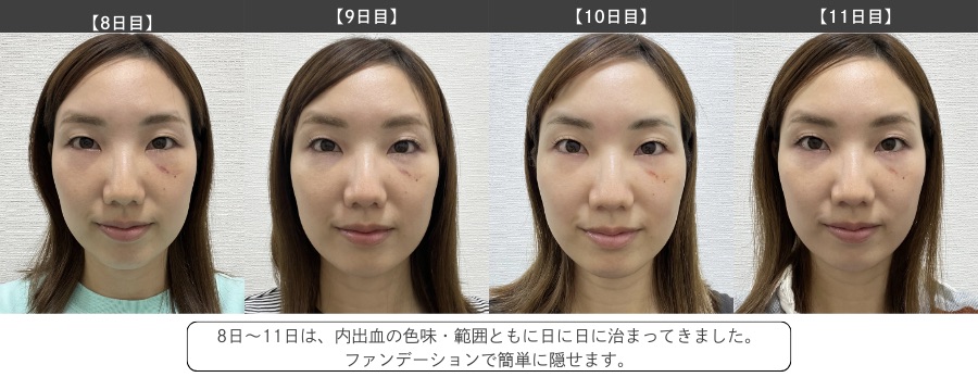 1週間目〜11日目