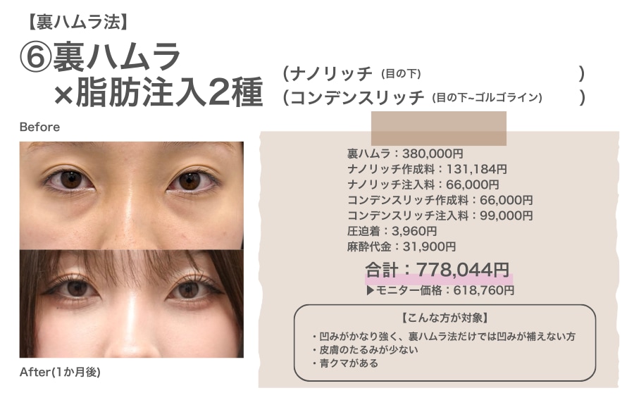 裏ハムラ法×ナノリッチ×コンデンスリッチ併用のリアルな費用と症例写真