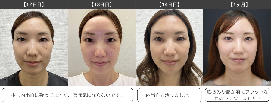 術後1ヶ月（ほぼ完成）