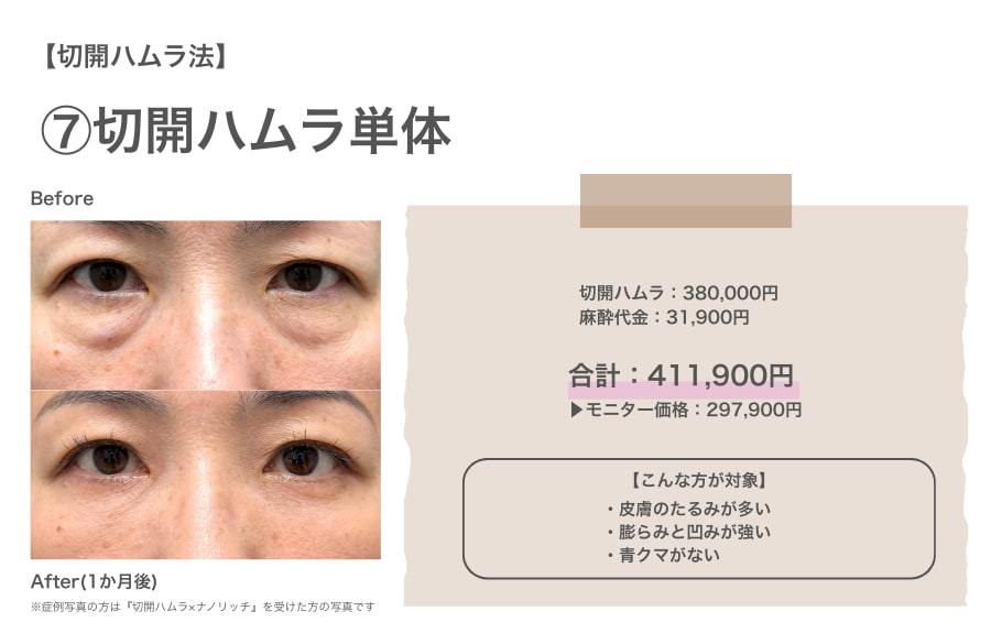 切開ハムラ法のリアルな費用と症例写真