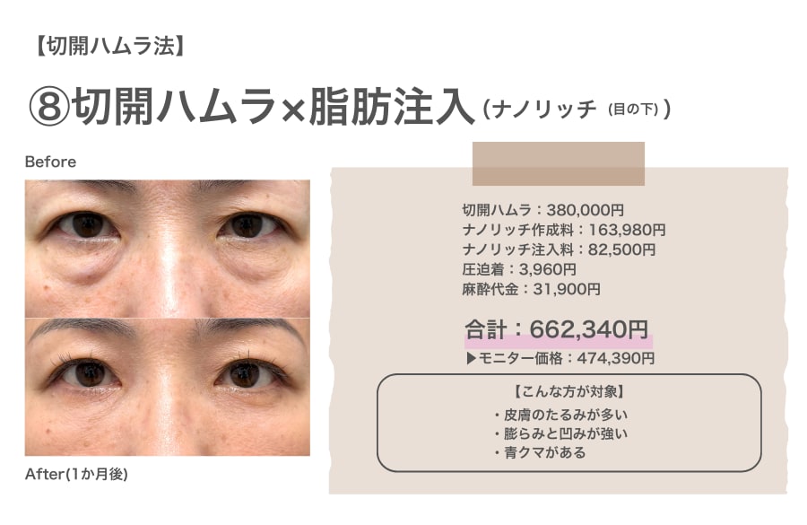 切開ハムラ法×ナノリッチのリアルな費用と症例写真
