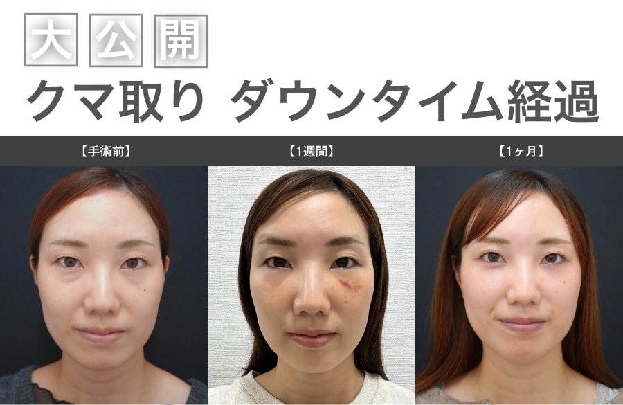 【写真公開】クマ取りのダウンタイムは腫れる？術前〜1ヶ月間のリアル経過レポ｜湘南美容クリニック蒲田院