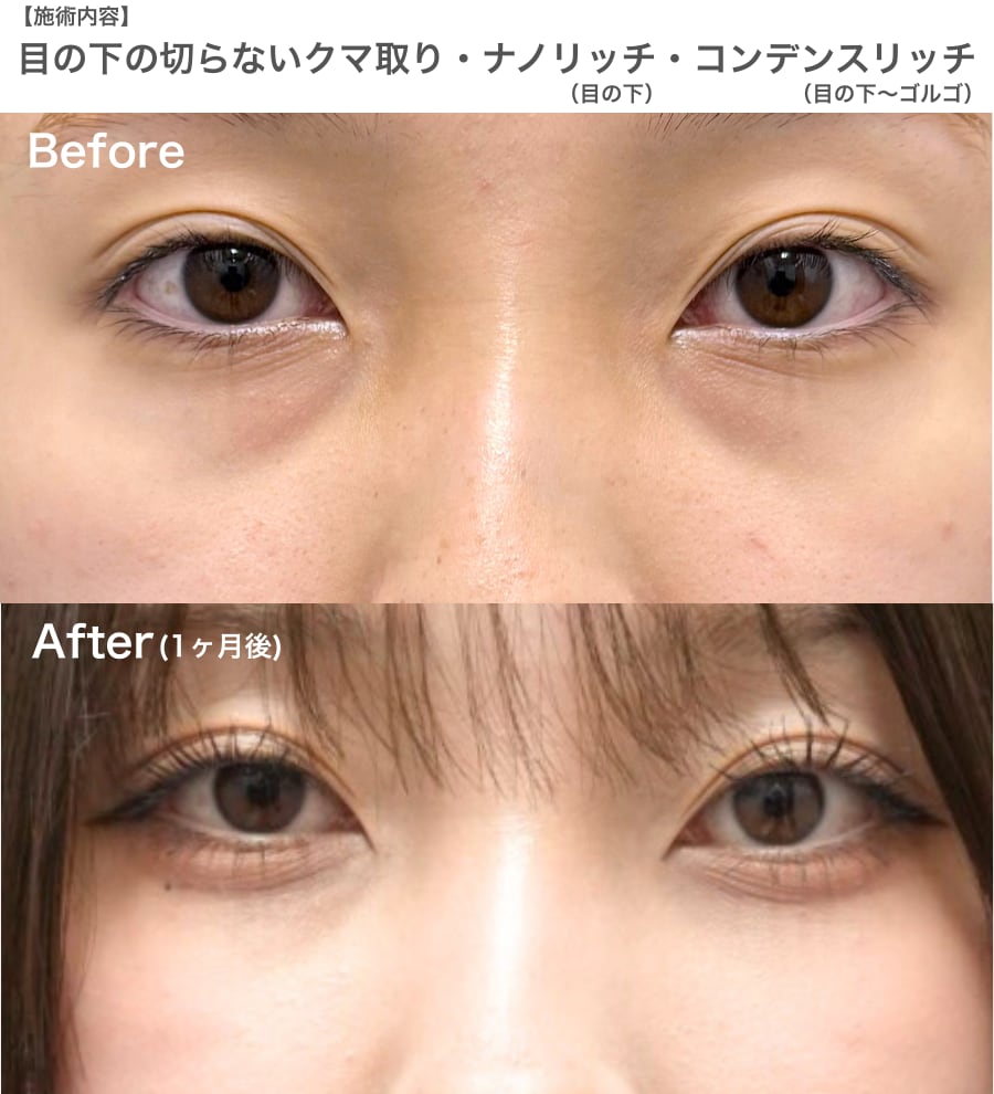 【10代】生まれつきのクマ