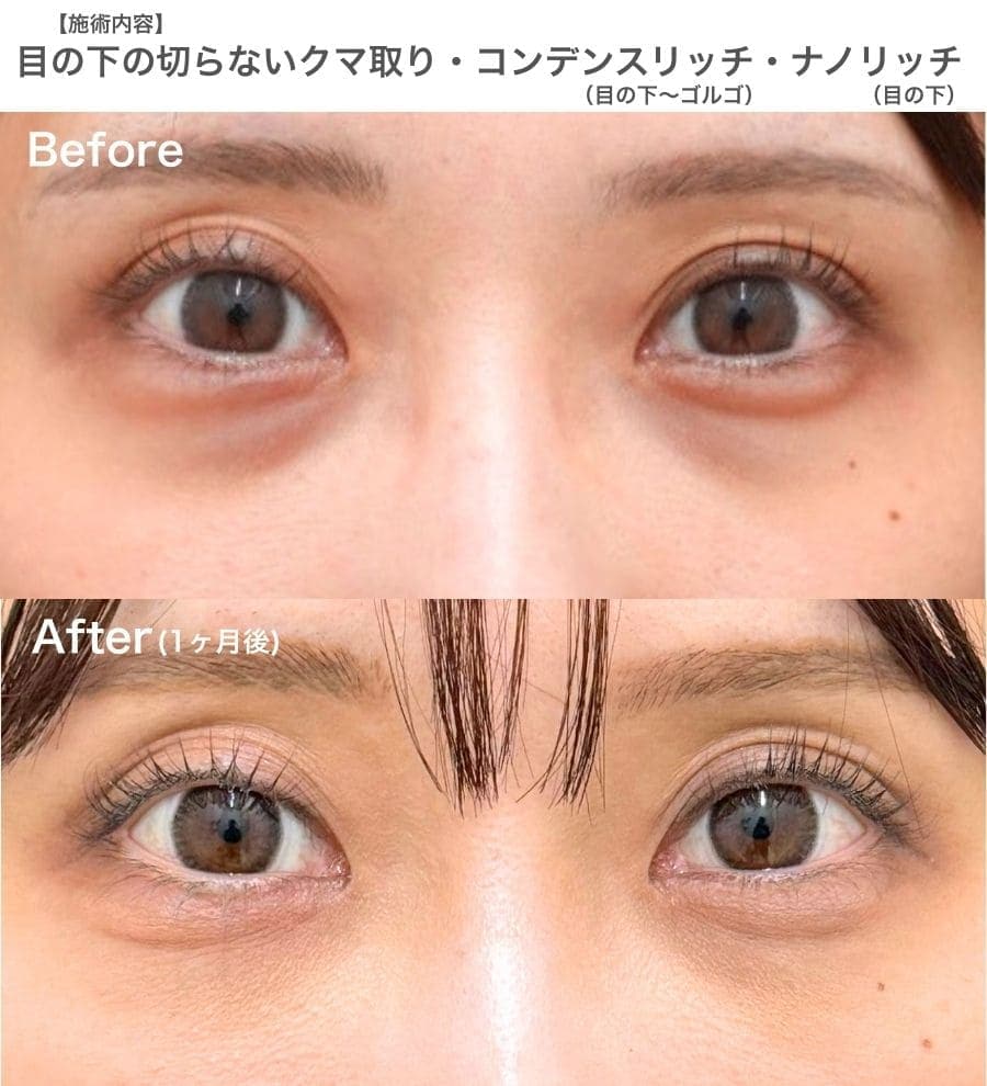 【30代】疲れ顔を解消し、メイク映えする明るい目元へ