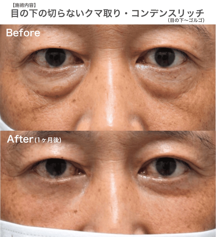 【40代】たるみ改善と脂肪注入で、マイナス10歳の若返り