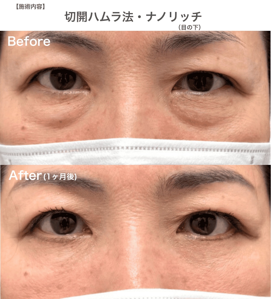 【50代】重度のクマ・たるみも一掃。叶える劇的な若返り