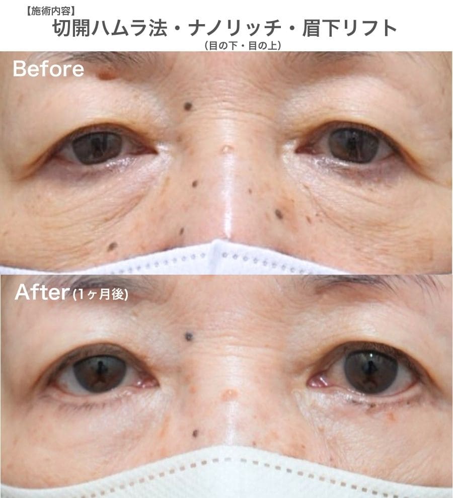 【60代以上】皮膚の余りも根本解決。お悩みに合わせた最適なアプローチで明るい表情へ