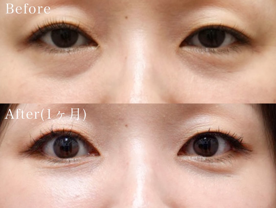 ②30代女性 裏ハムラ