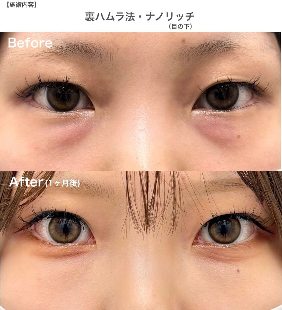 【20代】骨格的なクマ・将来のシワ予防