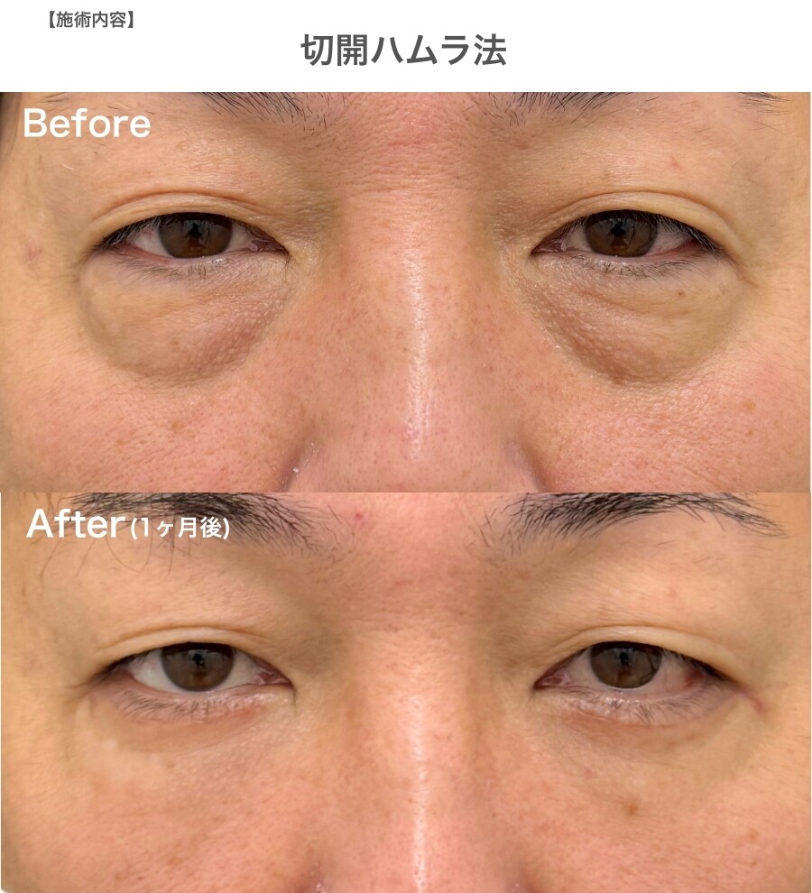 40代　【切開ハムラ】