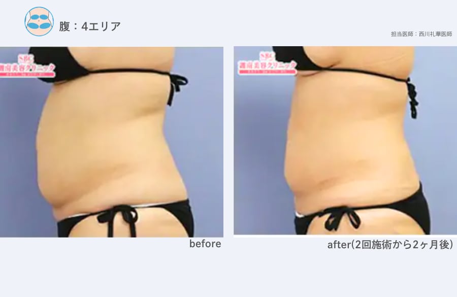 【腹】クールスカルプティング 症例写真