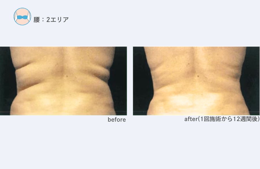 【背中】【太もも】クールスカルプティング 症例写真