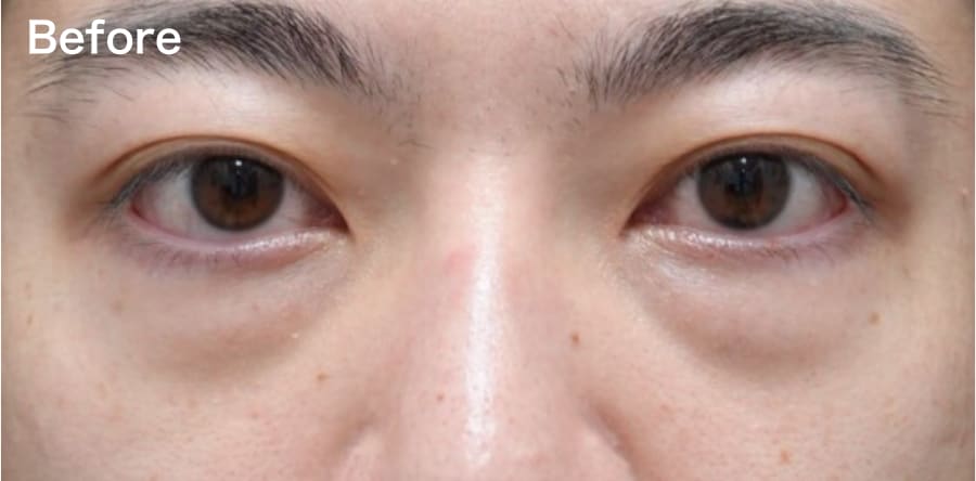 ”凹み””目の下のライン”が気になる方!