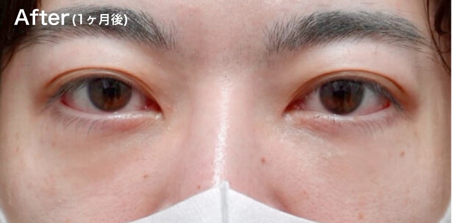 ”凹み””目の下のライン”が気になる方!