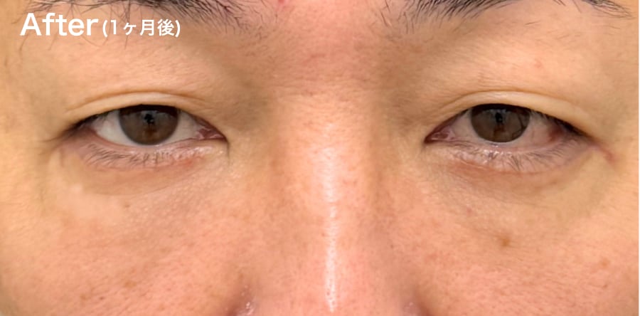 目の下の”たるみ”が気になる方!