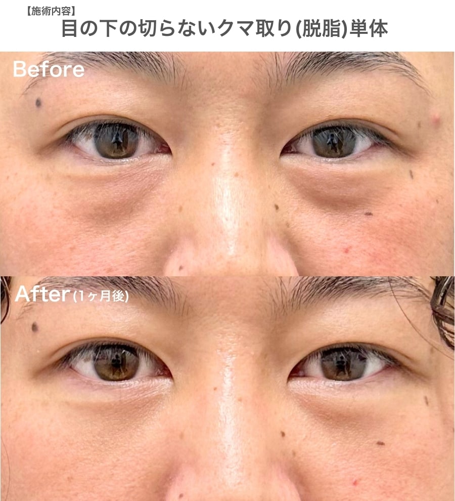 20代　【目の下の切らないたるみ取り】（脱脂）単体