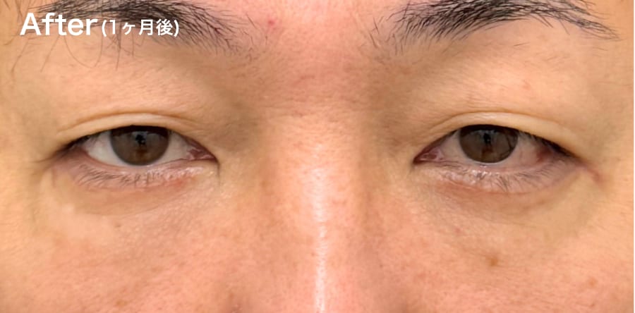 目の下の”たるみ”が気になる方！