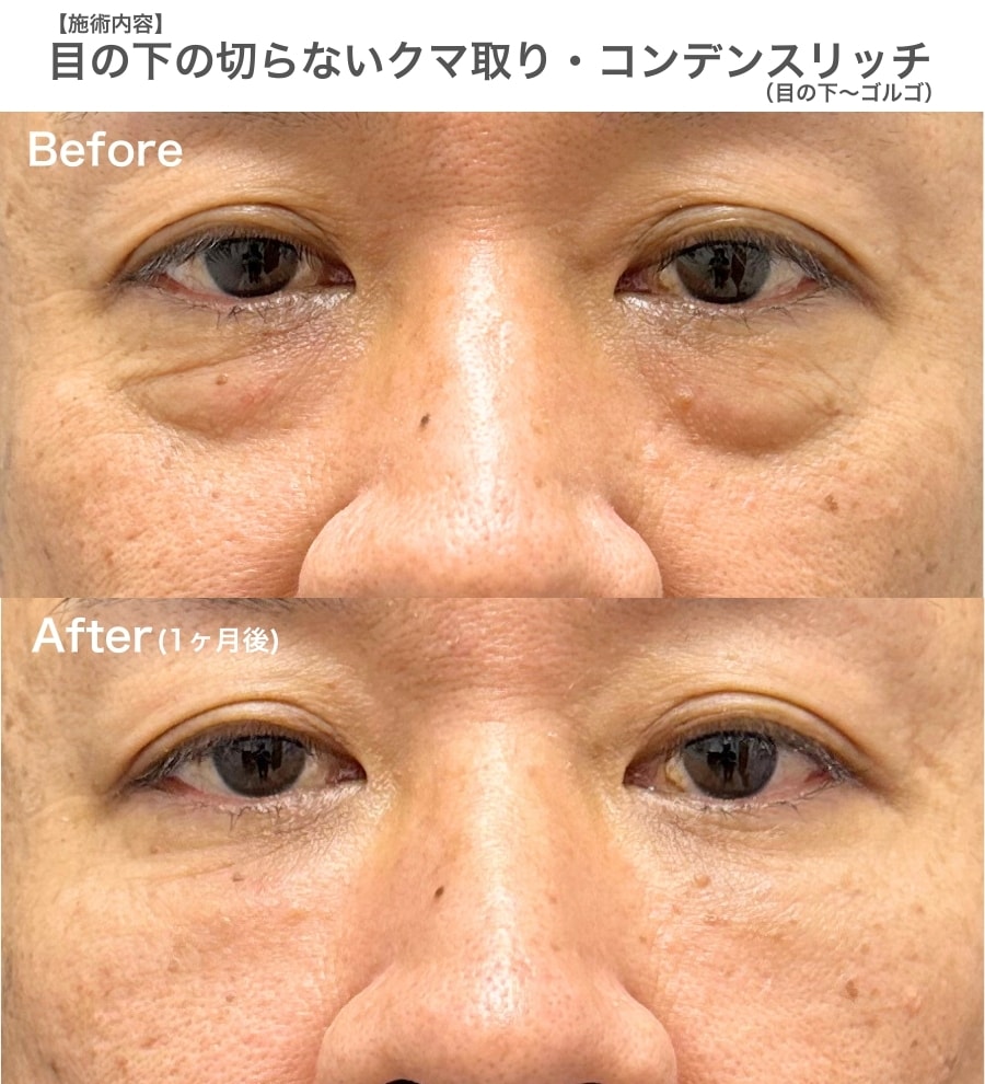 50代　【脱脂＋コンデンスリッチ（ボリュームを補う脂肪注入）】