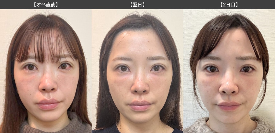【オペ直後〜2日目】
