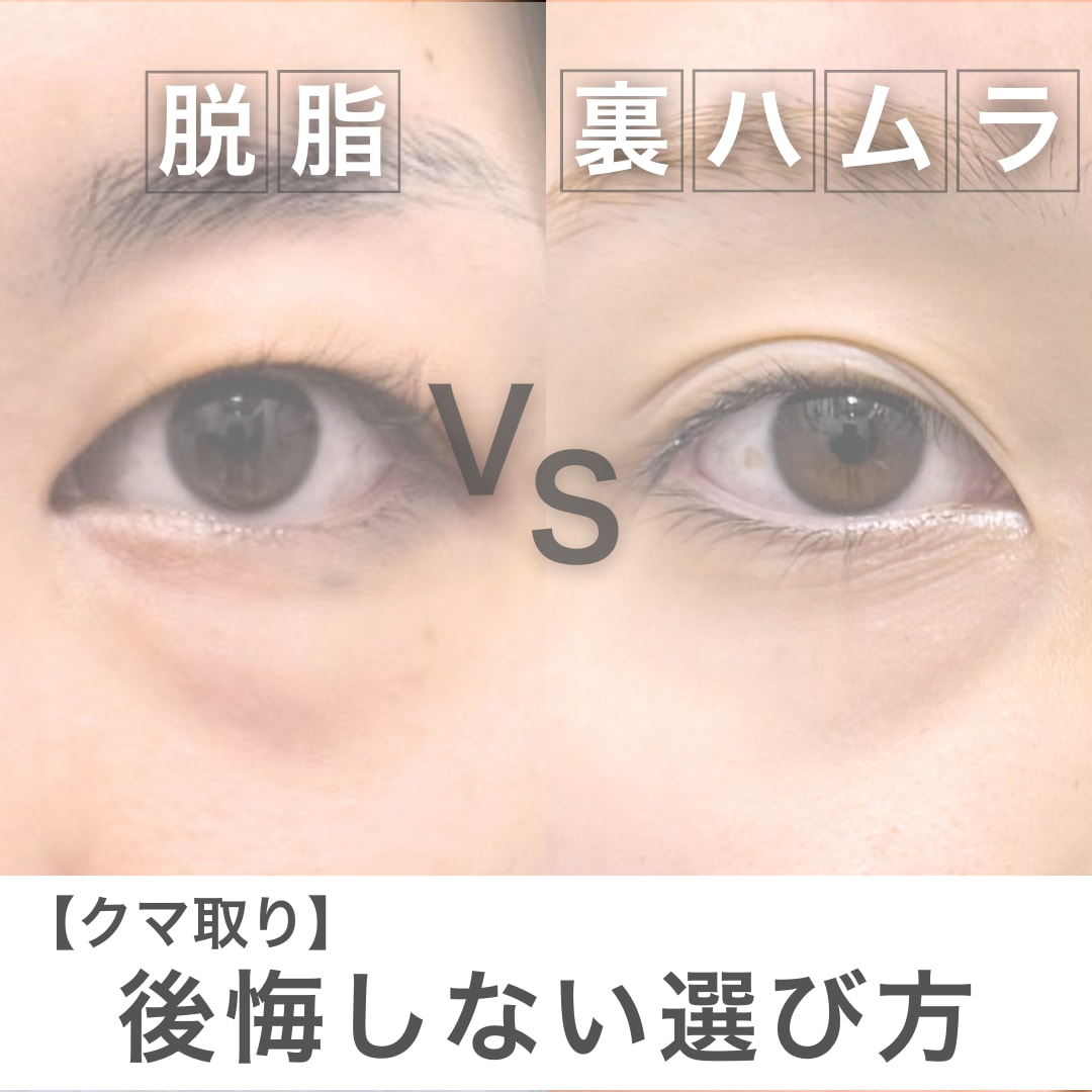 クマ取り失敗回避！脱脂vs裏ハムラ｜名医・上岡医師が教える後悔しない選び方