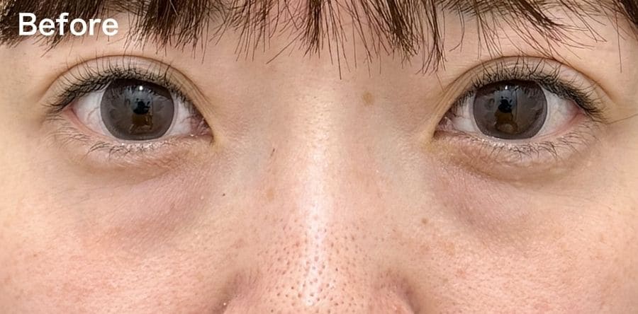 ”凹み””目の下のライン”が気になる方!