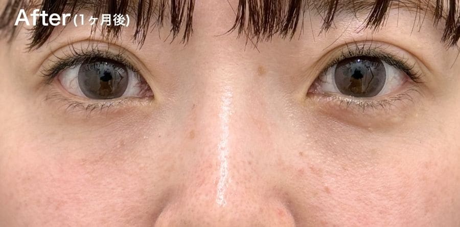 ”凹み””目の下のライン”が気になる方!