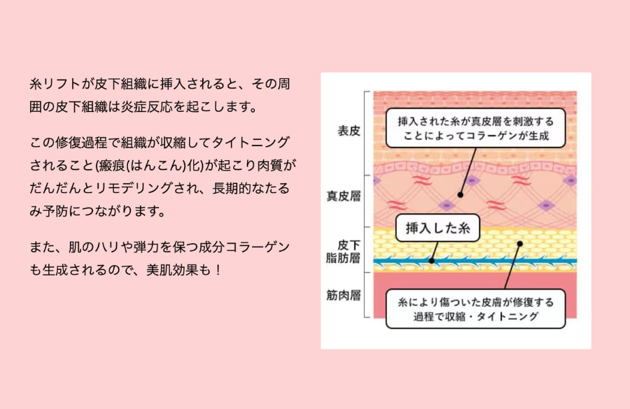① 糸の周囲に生まれる「コラーゲンの柱」（肌質向上・ハリ感アップ）