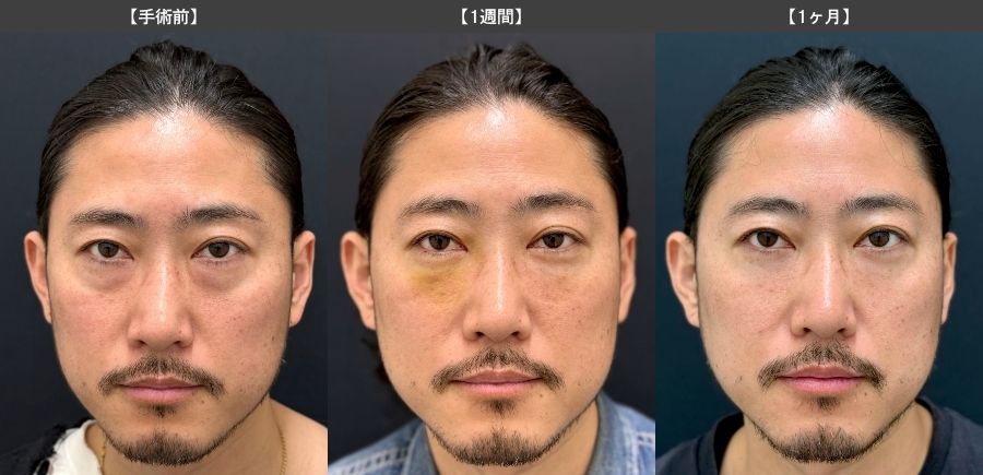 【手術前〜1ヶ月後】