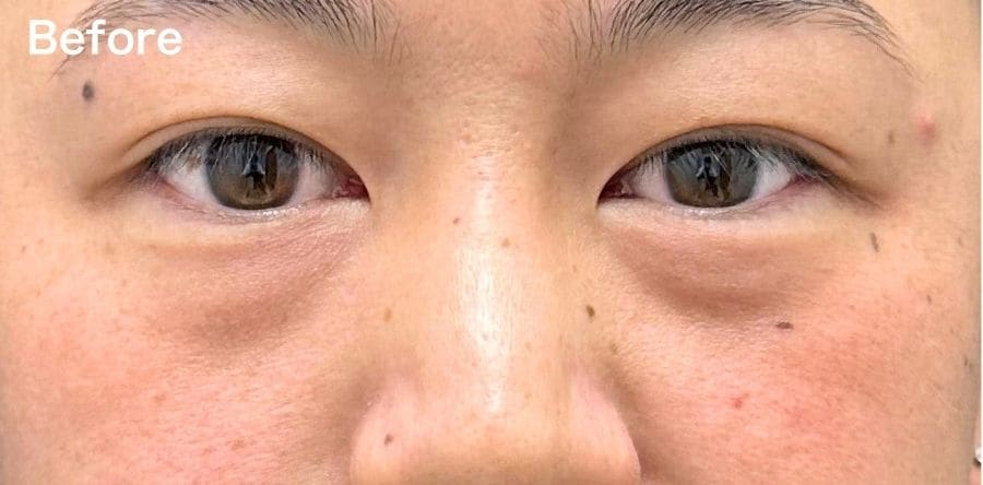 目の下の”ふくらみ”が気になる方！