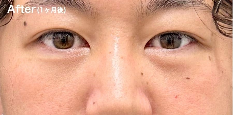 目の下の”ふくらみ”が気になる方！