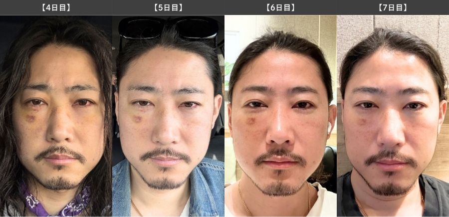 【4日目〜1週間】ダウンタイムが落ち着き始める時期
