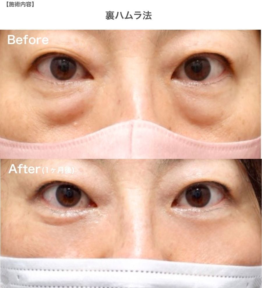 【皮膚のたるみが軽度の方】裏ハムラ法