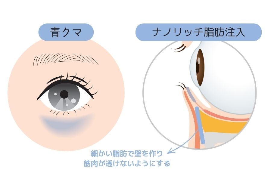 ②脂肪注入との組み合わせで「自然な若返り」を実現