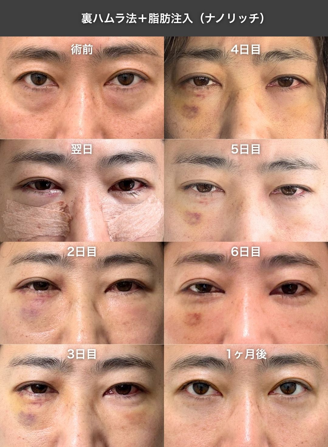 【手術前〜1ヶ月まとめ】