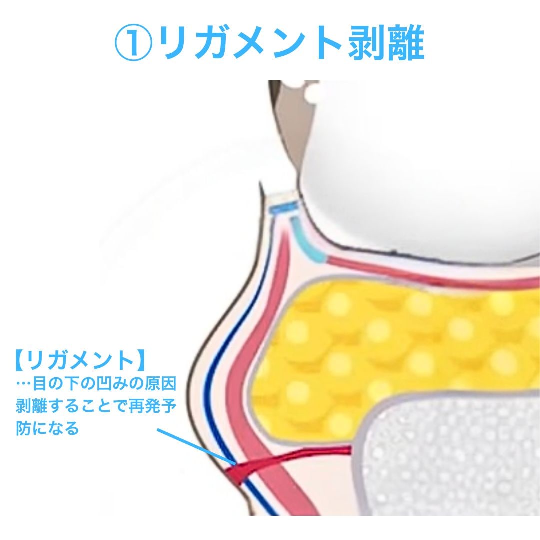こだわり①:リガメント(靭帯)剥離で再発を防ぐ