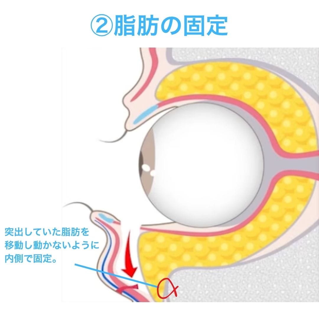 こだわり②:傷が残らない「内固定」へのこだわり