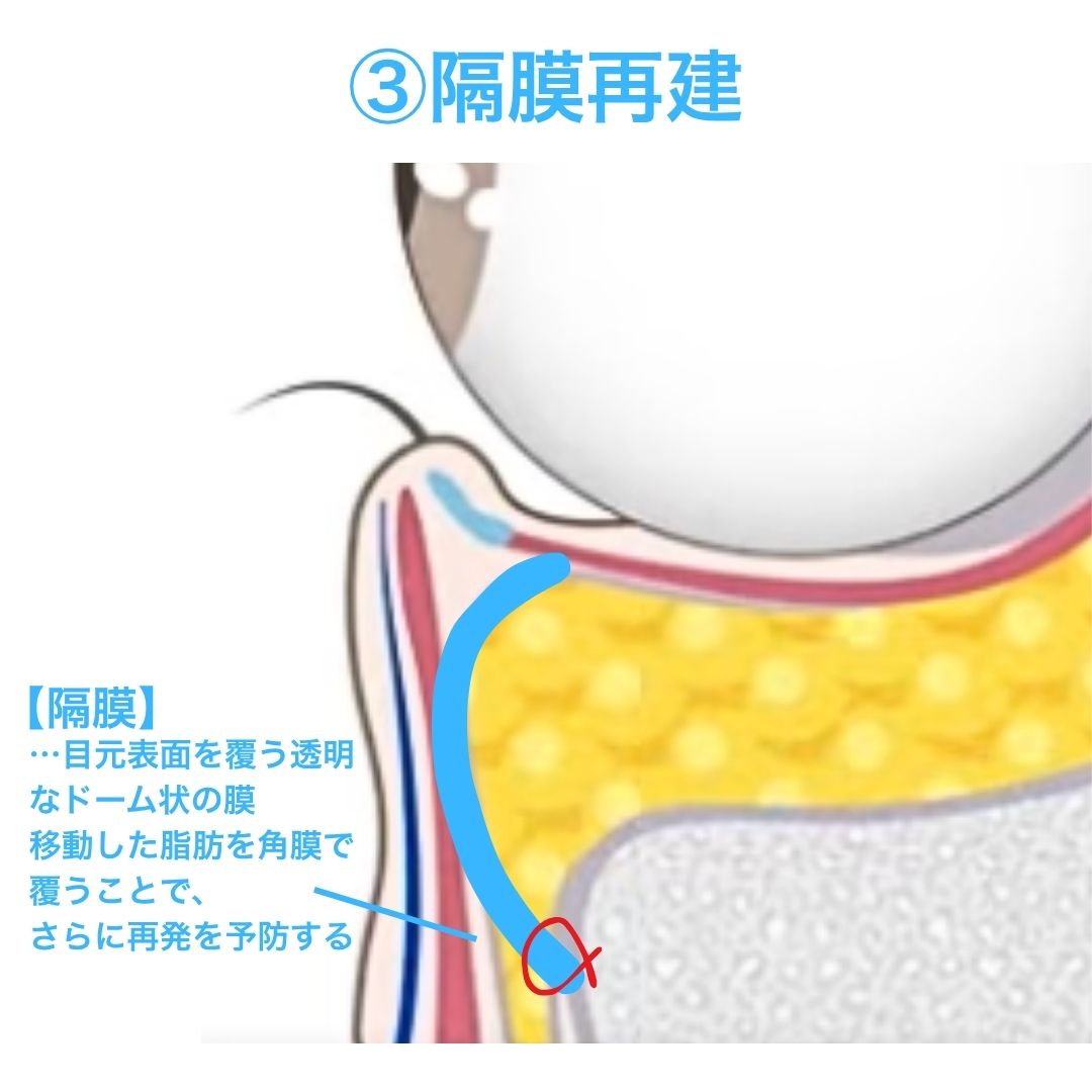 こだわり③:隔膜再建で脂肪の再突出を防ぐ