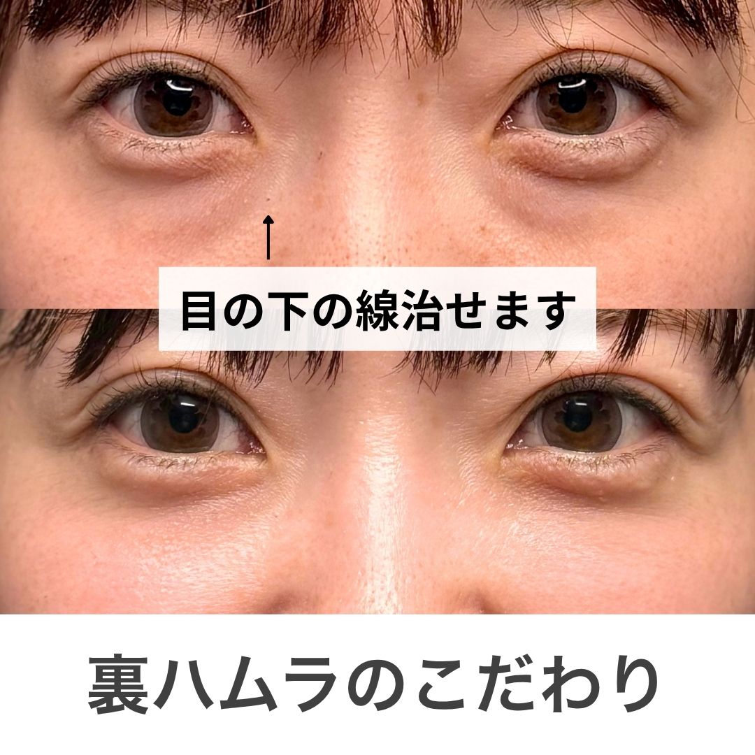 目の下の線が気になる方へ|実はそれ、”凹み”のサインかもしれません