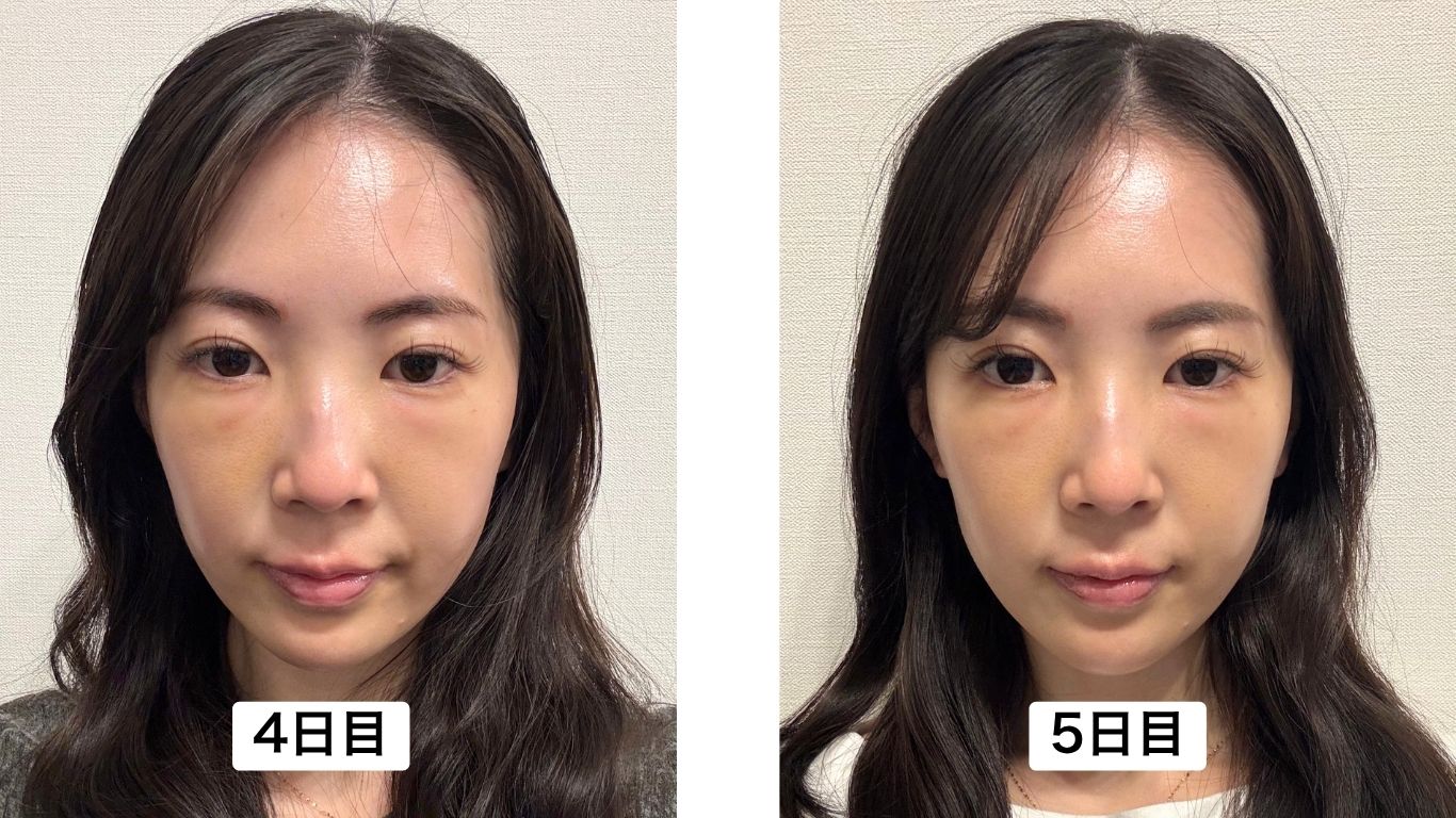 4日目〜7日目
